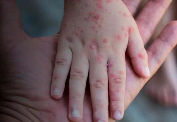 Brasil registra casos de varíola dos macacos em dois bebês