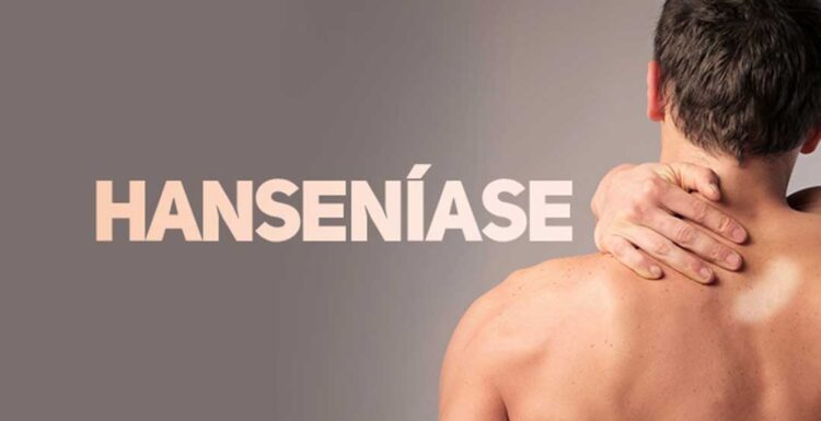 Neste sábado, 11 UBSs abrem para atendimento especial a pacientes com manchas suspeitas de Hanseníase