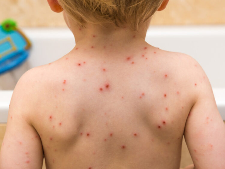 Como a doença pode afetar o neurodesenvolvimento de bebês