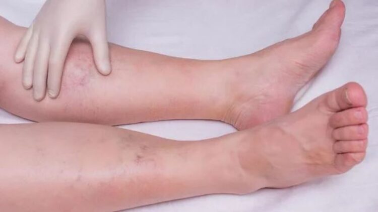 Conheça tratamentos que melhoram os sintomas do linfedema