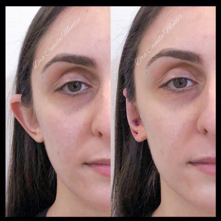 O fim das “orelhas de abano”